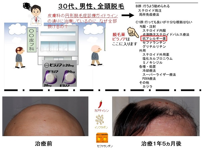 円形脱毛症　病院